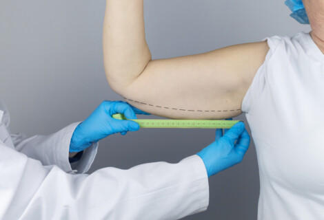Profissional avaliando o braço de paciente com fita métrica para planejamento de tratamento para retirar excesso de pele do braço.