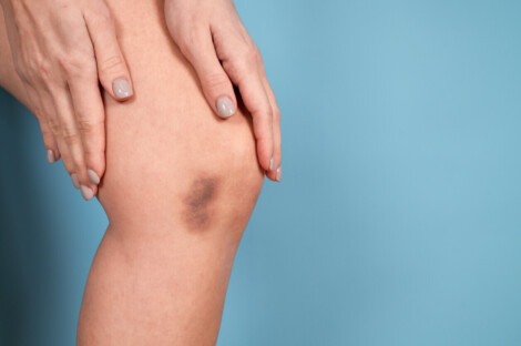close-up de perna com hematoma escuro, representando possível sintoma do lipedema