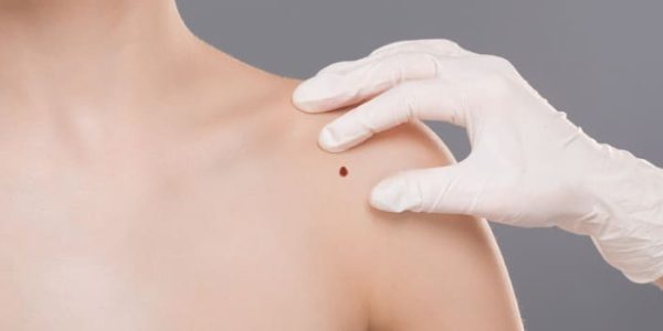 avaliação para cirurgia para retirar tumor de pele