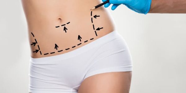 abdominoplastia em âncora: entenda o que é