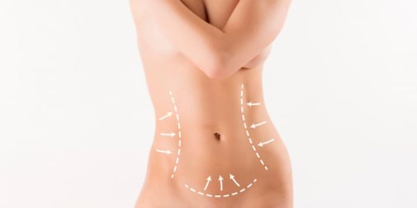 abdominoplastia pós-bariátrica: