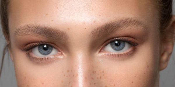 Mulher após blefaroplastia