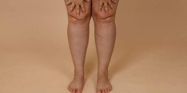 Lipedema