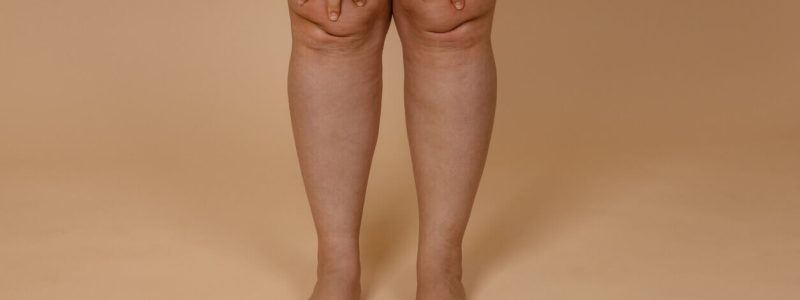 Lipedema